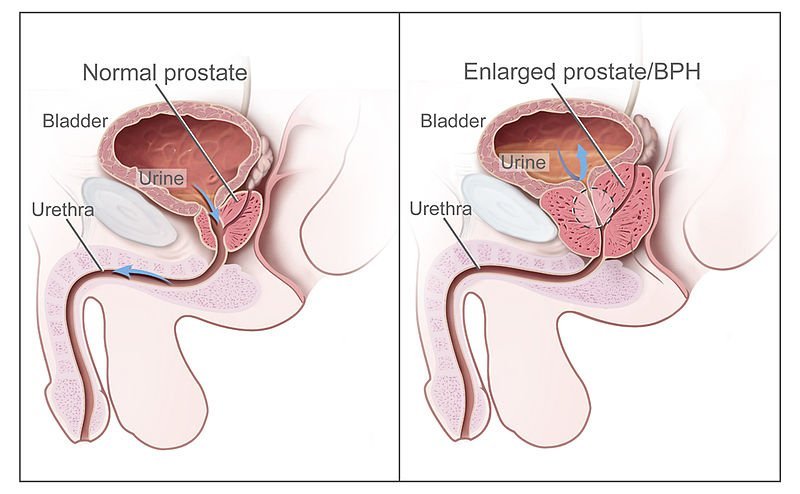 Kalenjar prostat dan prostat bengkak (BPH)
