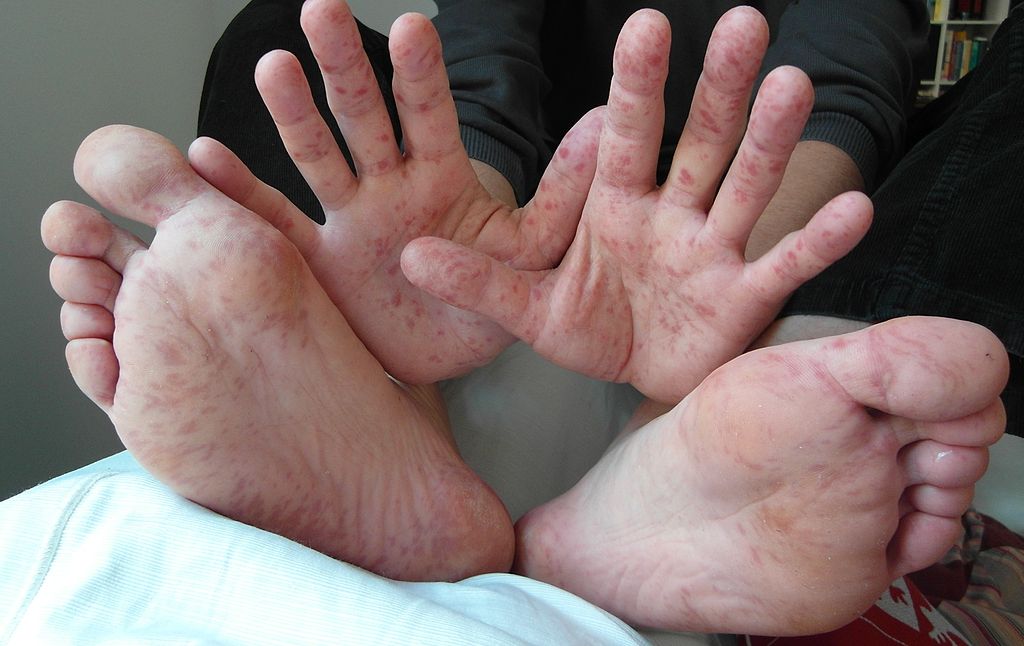 Penyakit Kaki Tangan Dan Mulut Hfmd Punca Dan Cara Rawatan The Diagnosa