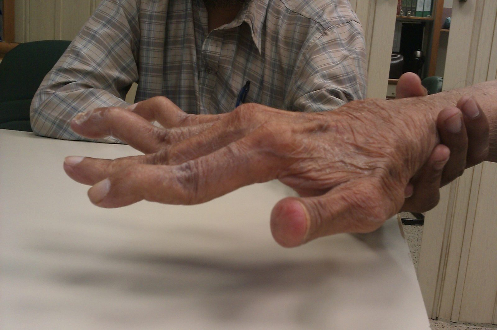 penyakit rheumatoid arthritis