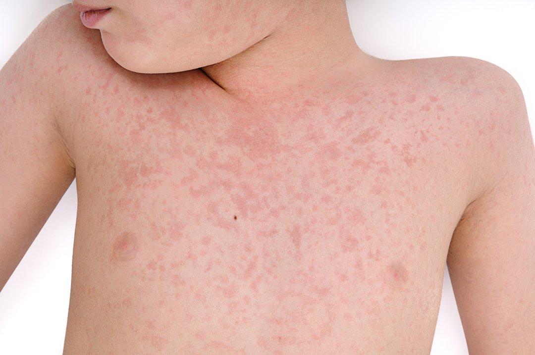 Demam Campak Measles Punca Simptom Dan Rawatan The Diagnosa