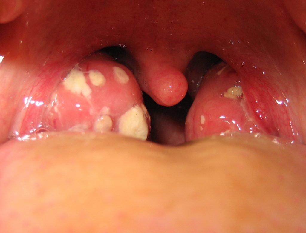 Tonsil bengkak