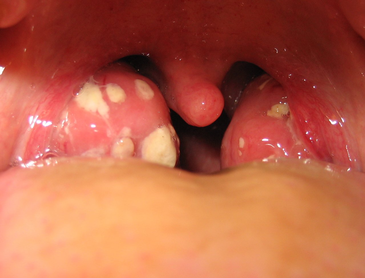 Tonsil Bengkak Punca Simptom Dan Rawatan The Diagnosa