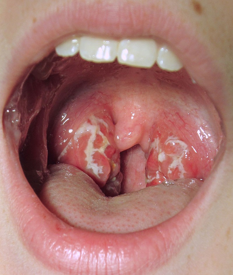 Tonsil bengkak atau tonsilitis yang menyebabkan tonsil merah dan meradang