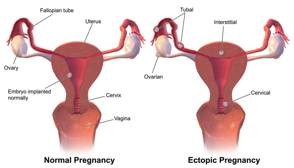 Kandungan luar rahim merupakan salah satu keadaan yang berbahaya bagi seseorang ibu. Ianya boleh menyebabkan kematian jika tidak dirawat diperingkat awal.