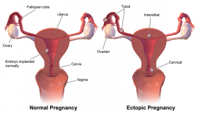 Fibroid: Punca, Faktor Risiko dan Cara Rawatan - The Diagnosa