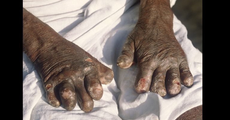 Penyakit Kusta: Punca, Simptom dan Rawatan - The Diagnosa