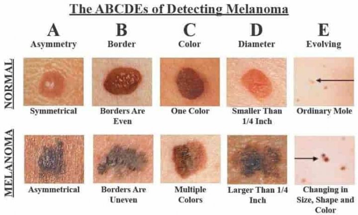 Ingatkan Tahi Lalat. Rupanya Kanser Melanoma - The Diagnosa