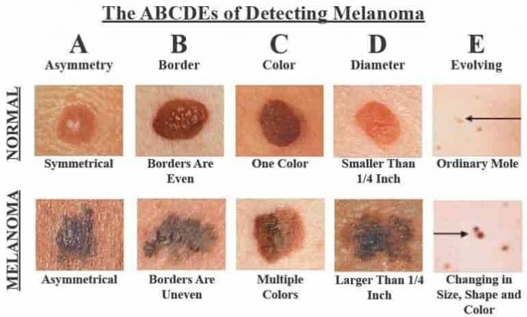 Ingatkan tahi lalat. Rupanya kanser melanoma - The Diagnosa