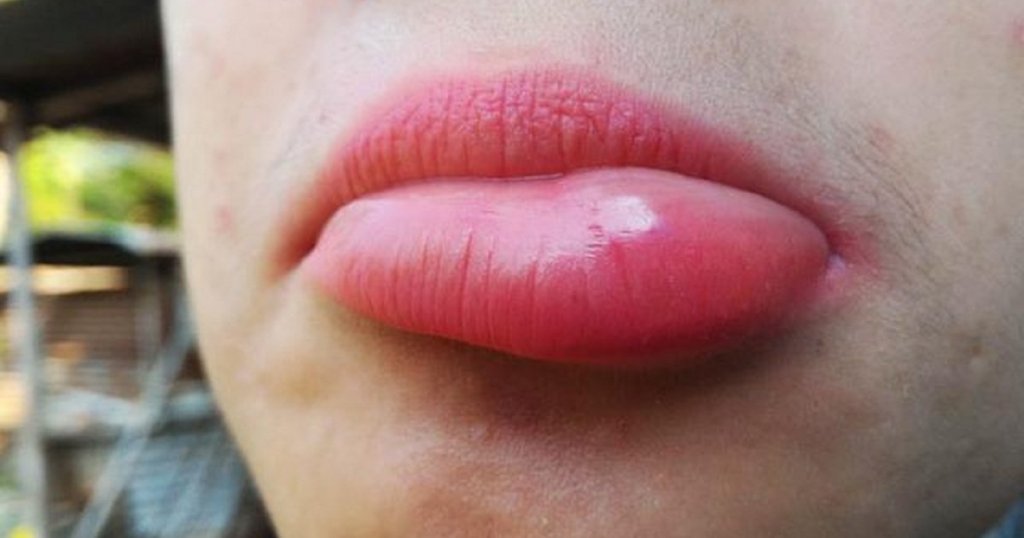 bibir bengkak