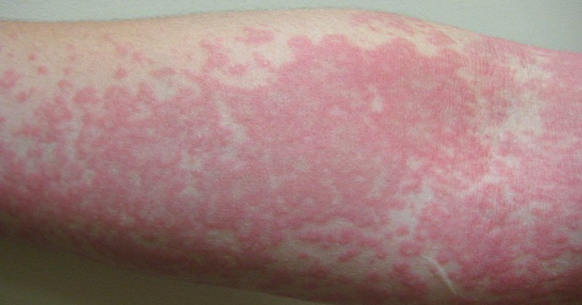 alergi kulit atau alahan kulit