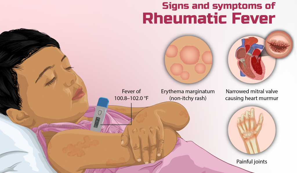 demam reumatik