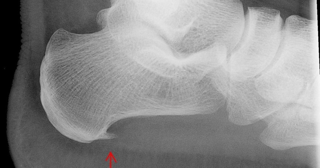 heel spur atau calcaneal