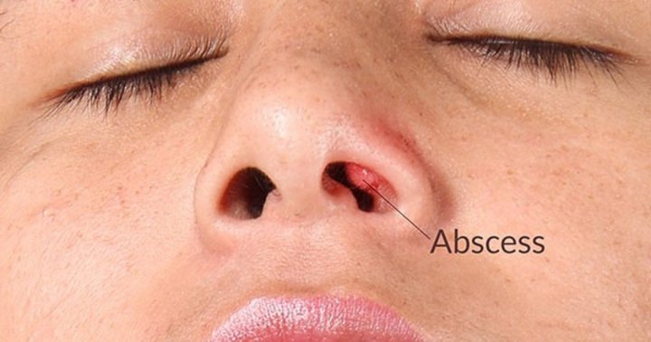 Jerawat Hidung: Punca dan Cara Rawatan - The Diagnosa