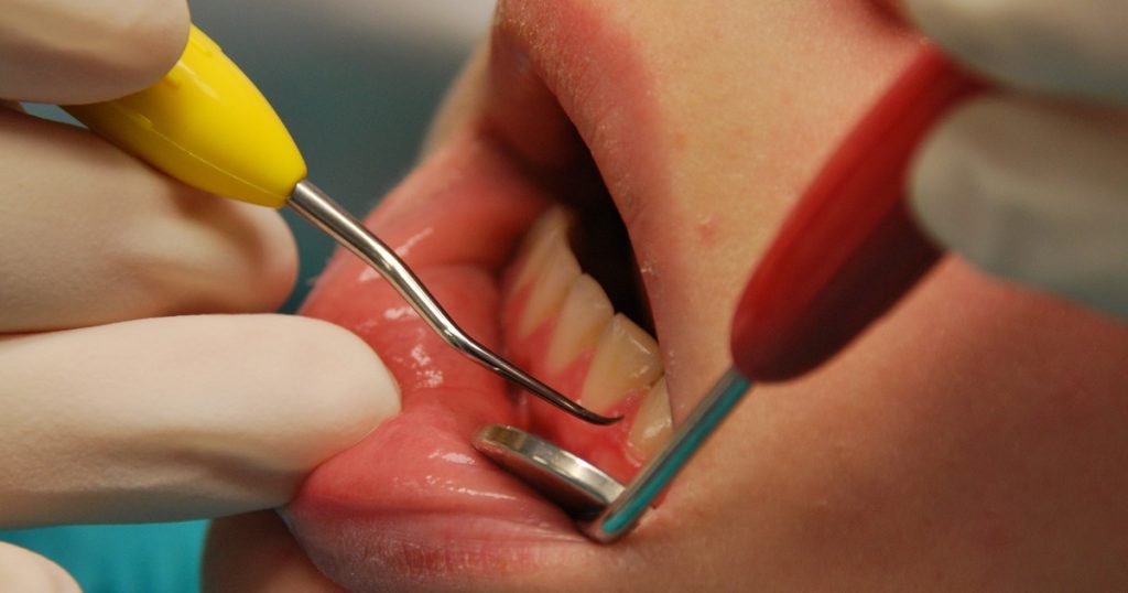 apakah itu scaling gigi