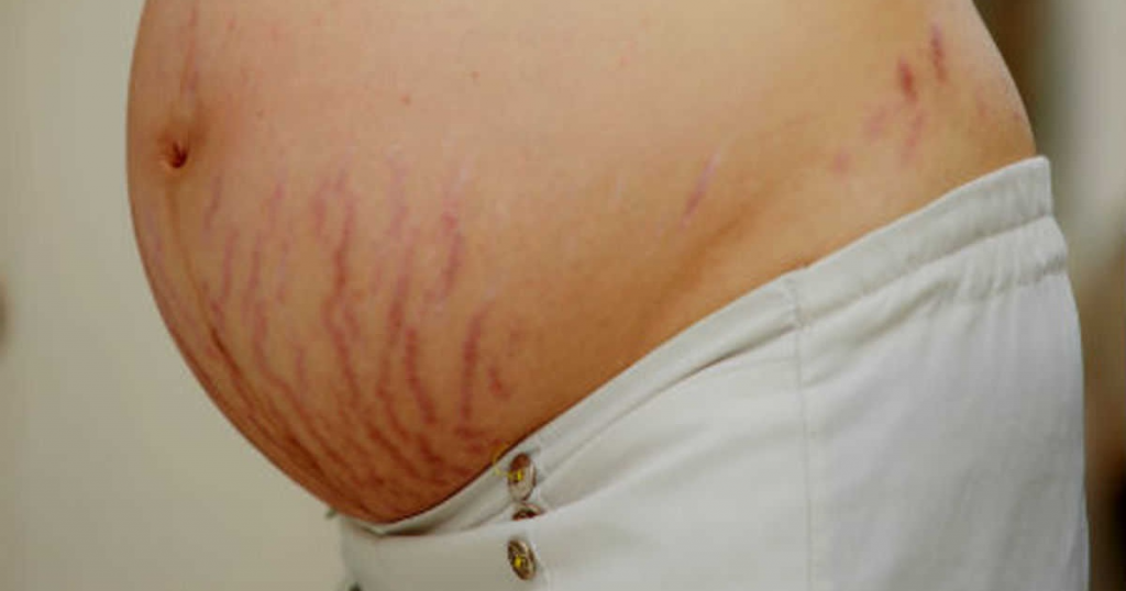 stretch mark tanda regangan