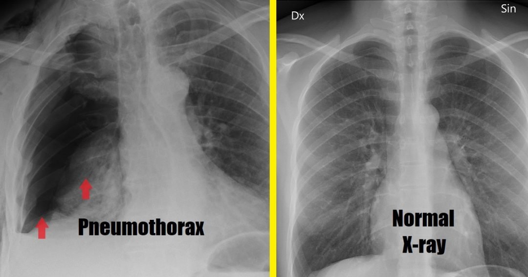 Pneumothorax: Punca, Simptom Dan Rawatan - The Diagnosa