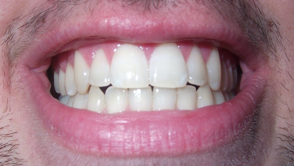 jumlah gigi kacip kekal dalam mulut orang dewasa