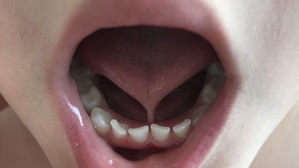 lidah pendek (tongue tie)