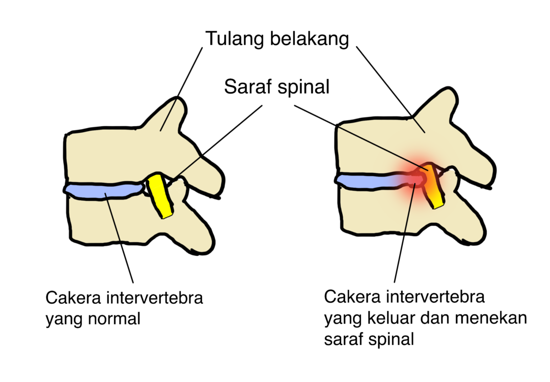 Slipped Disc Punca Simptom Dan Cara Rawatan The Diagnosa Hot Sex Picture